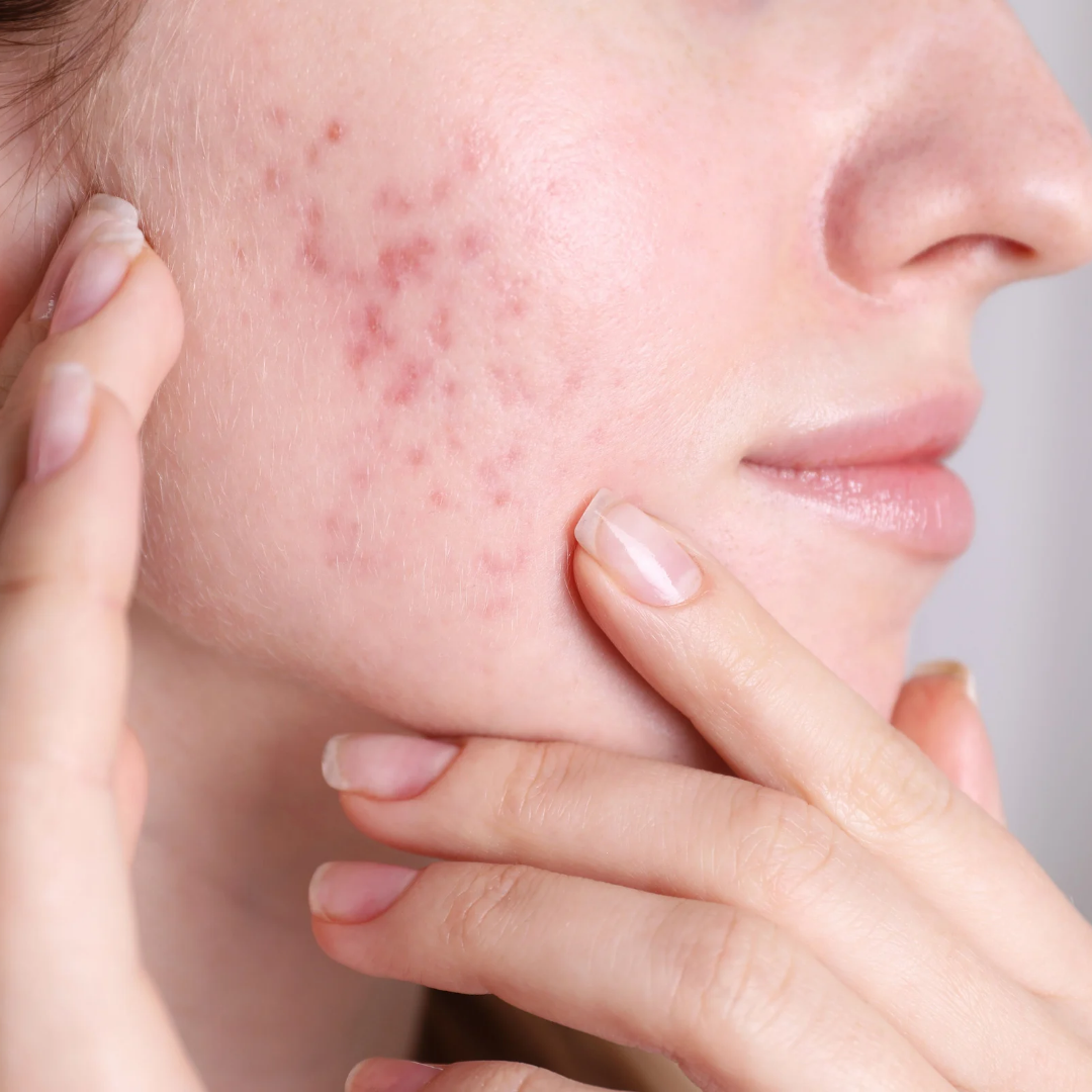 Acne Products